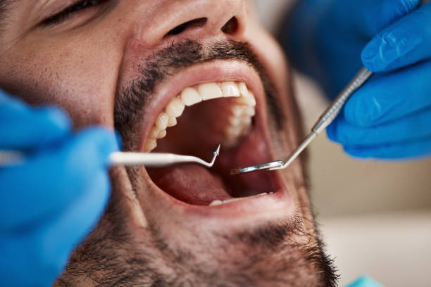 Best Emergency Dental Care for Broken or Chipped Teeth in Connelly Springs, NC